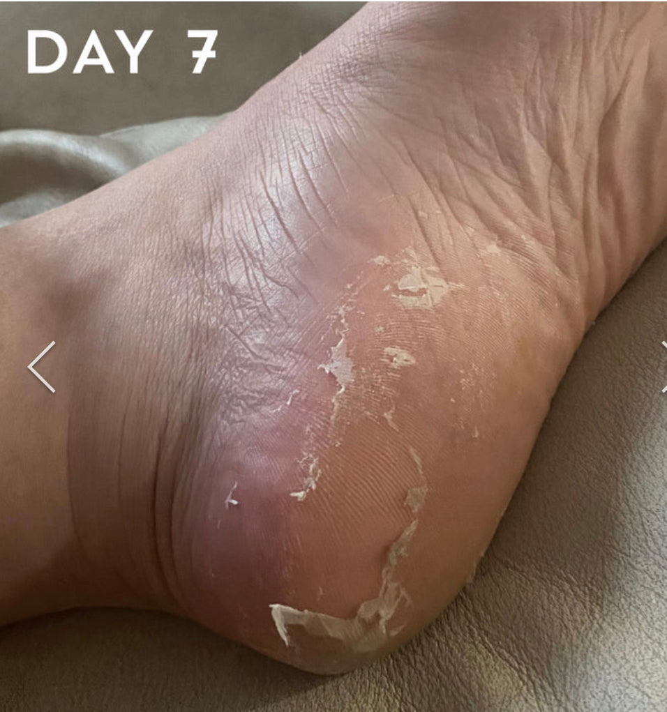 BeautyPro Foot And Callus Peel