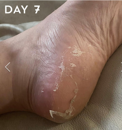 BeautyPro Foot And Callus Peel